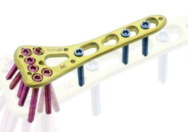 Дистальна променева поліаксіальна пластина, права( Double Medical Technology Inc.)